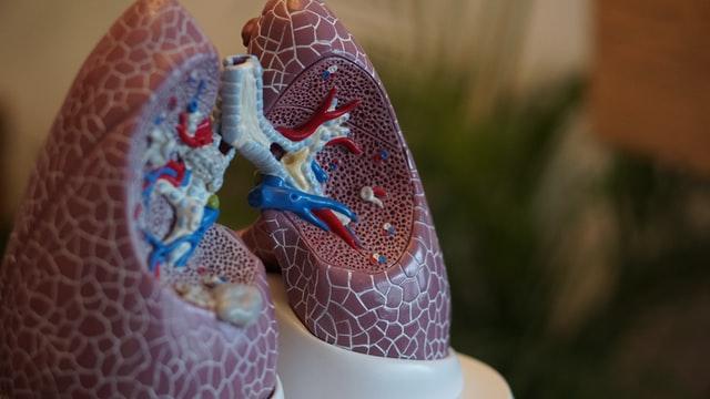 Tuberculosis